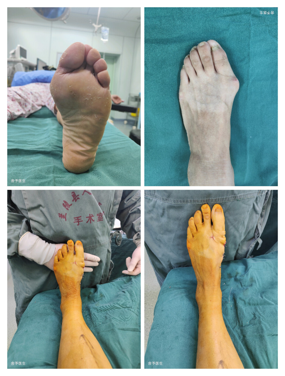 微创手术矫正拇外翻