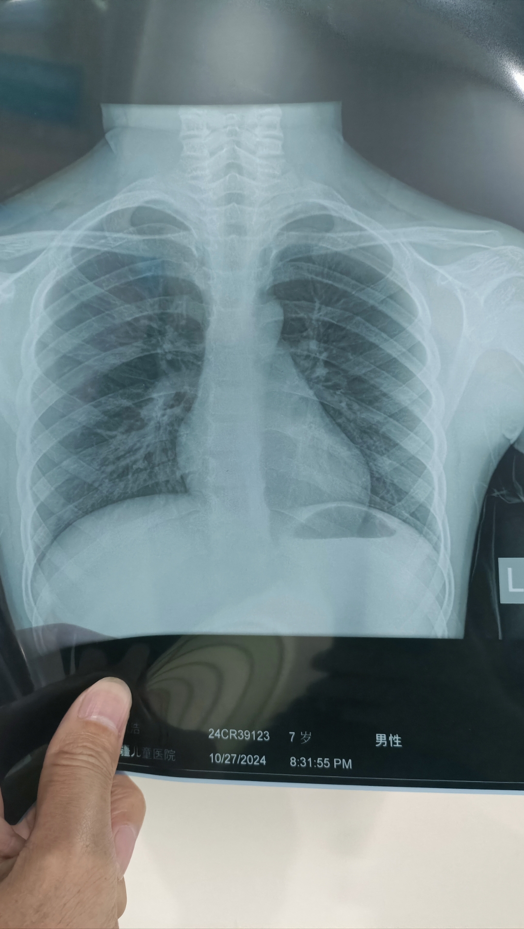 大神们看看,有肺炎么?