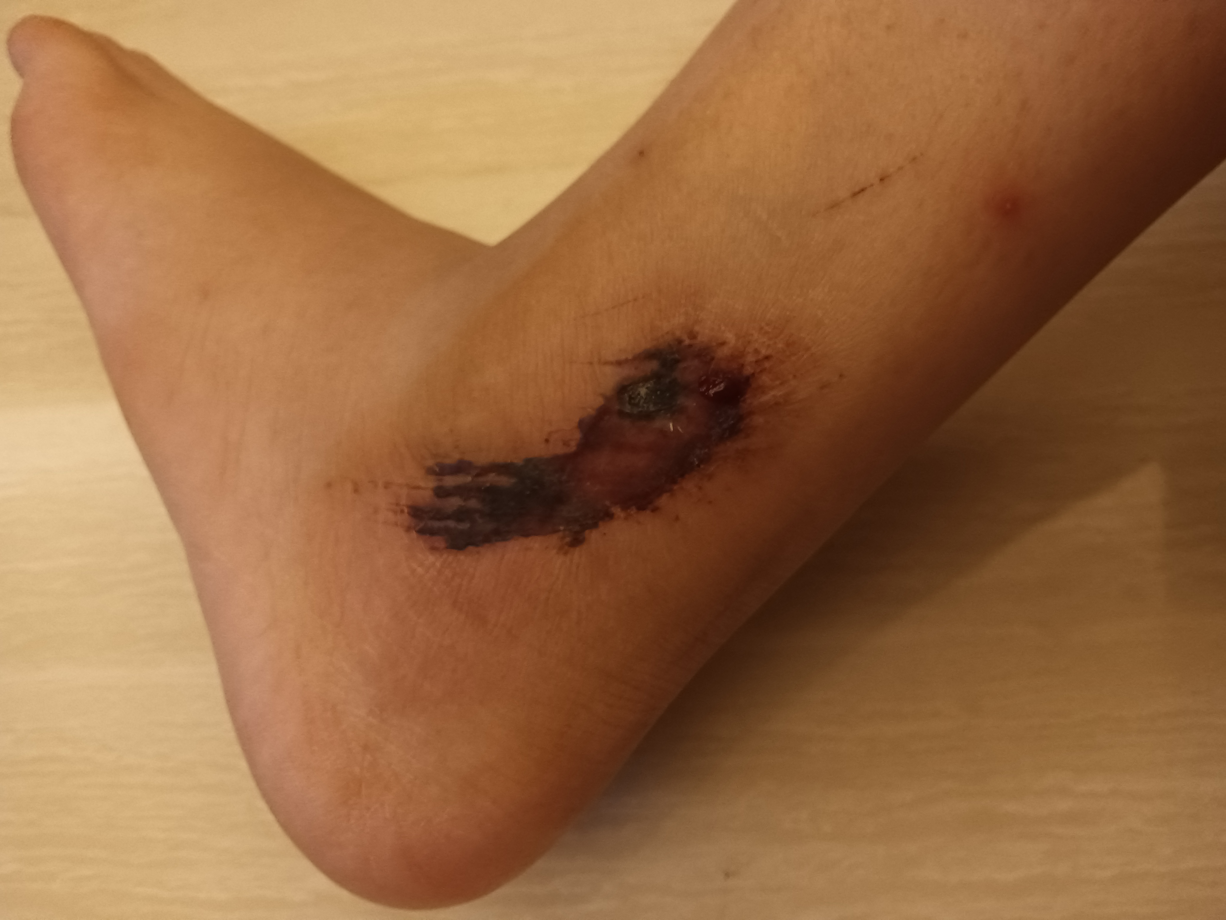 脚上蹭破照片骑车时停车时脚被地上磨了紫北小区的时候有三轮车上夹痛