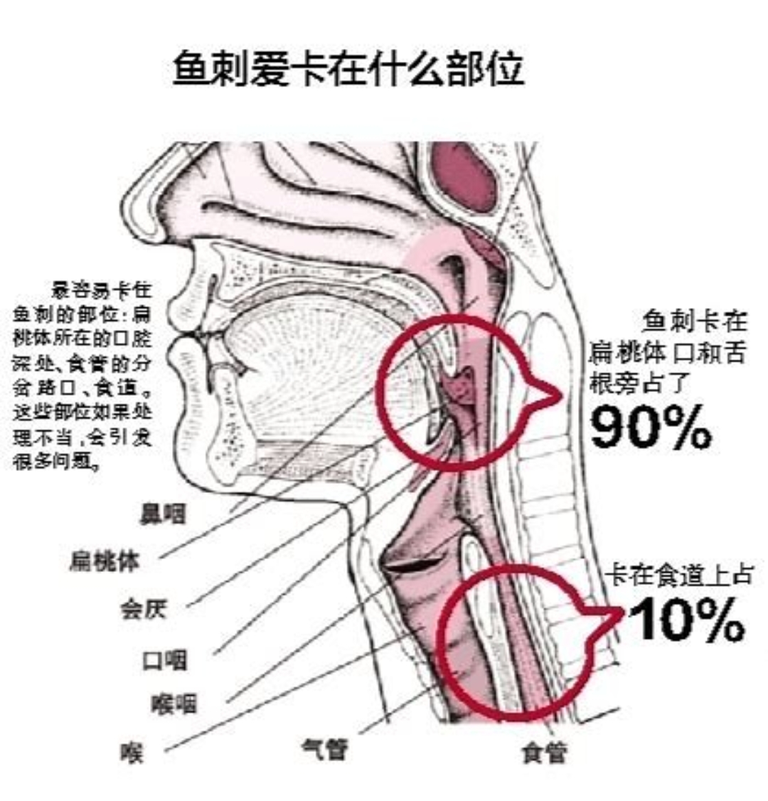 鱼刺卡在喉咙里图片