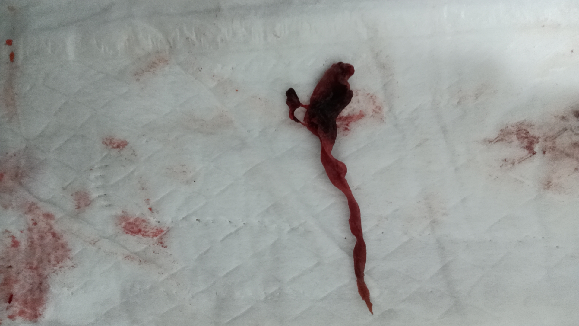 第一个图片是孕囊吗?