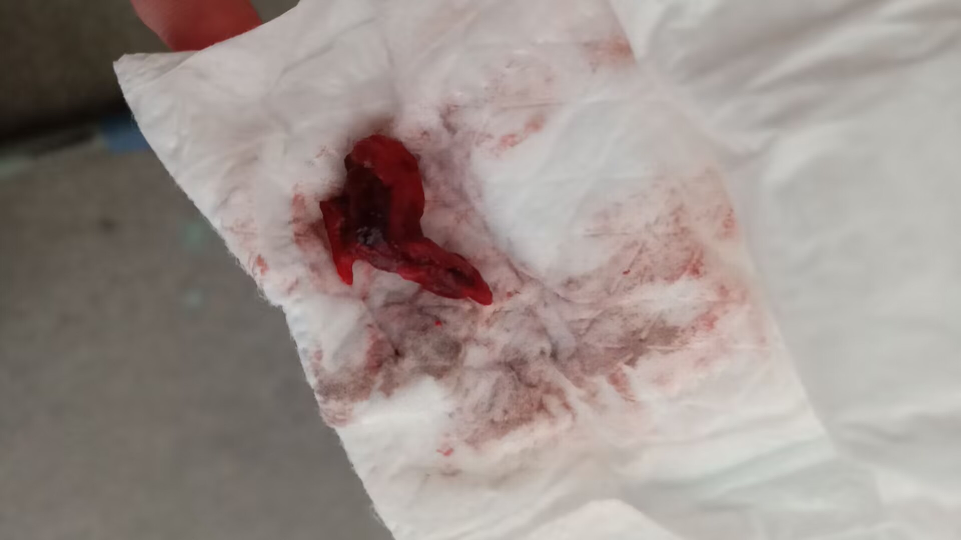 第一个图片是孕囊吗?