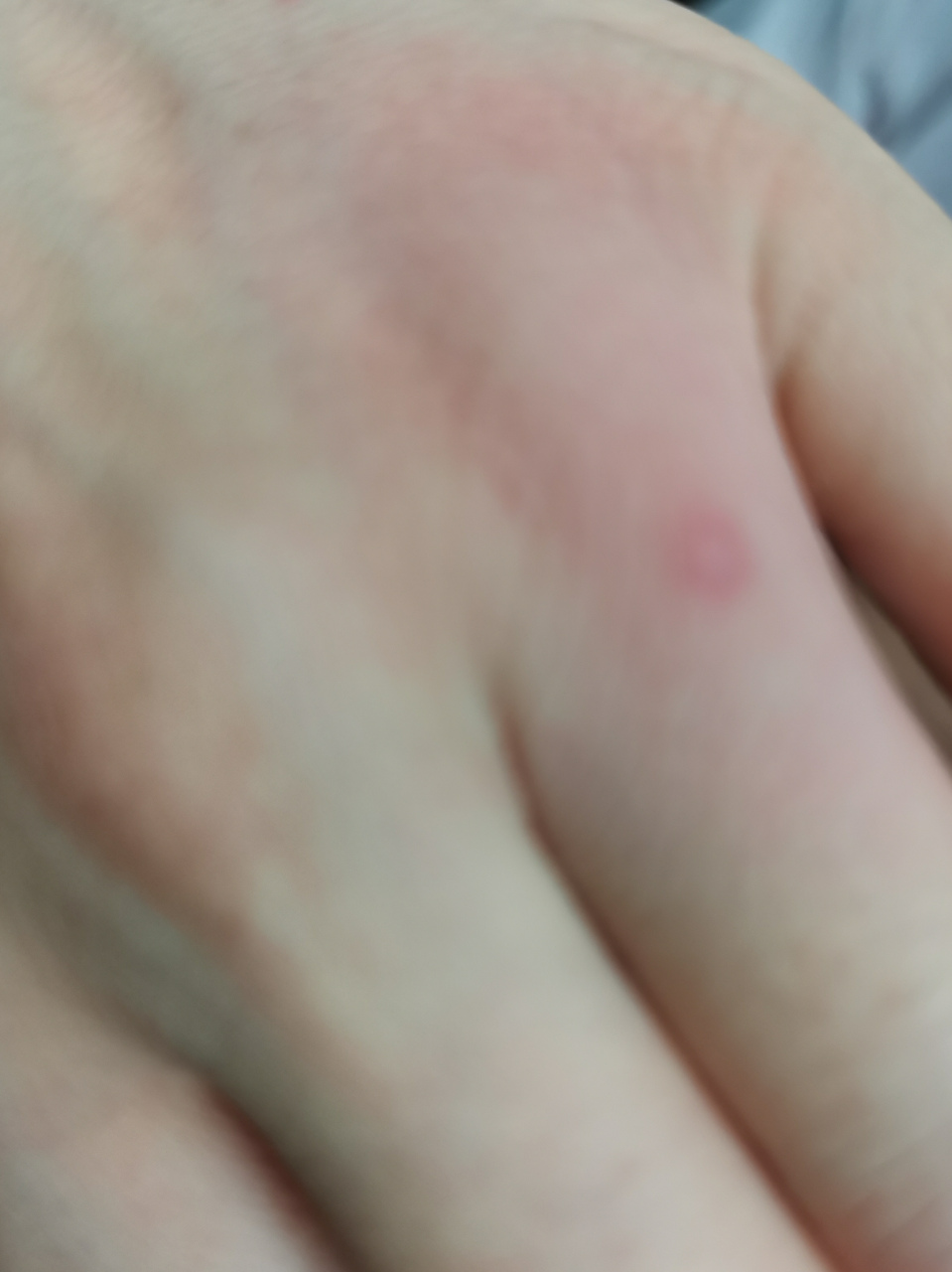 去田里拔草被蚂蚁咬了一口,已经两天了,红肿痒痛,感觉胳膊也点胀痛感