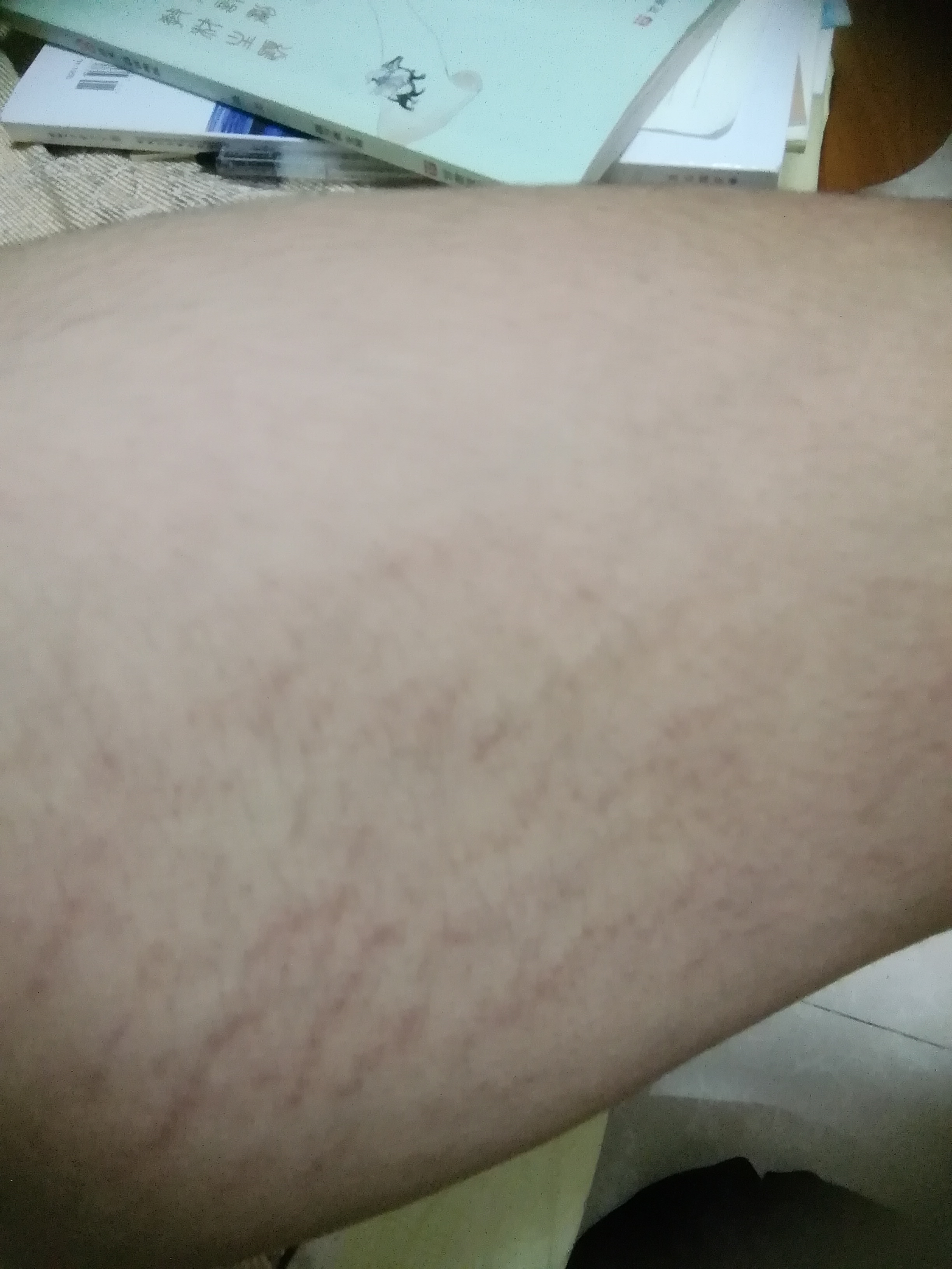 我是一名高一体育生,我大腿两边一直有这种红斑条快一二年了,有时很多