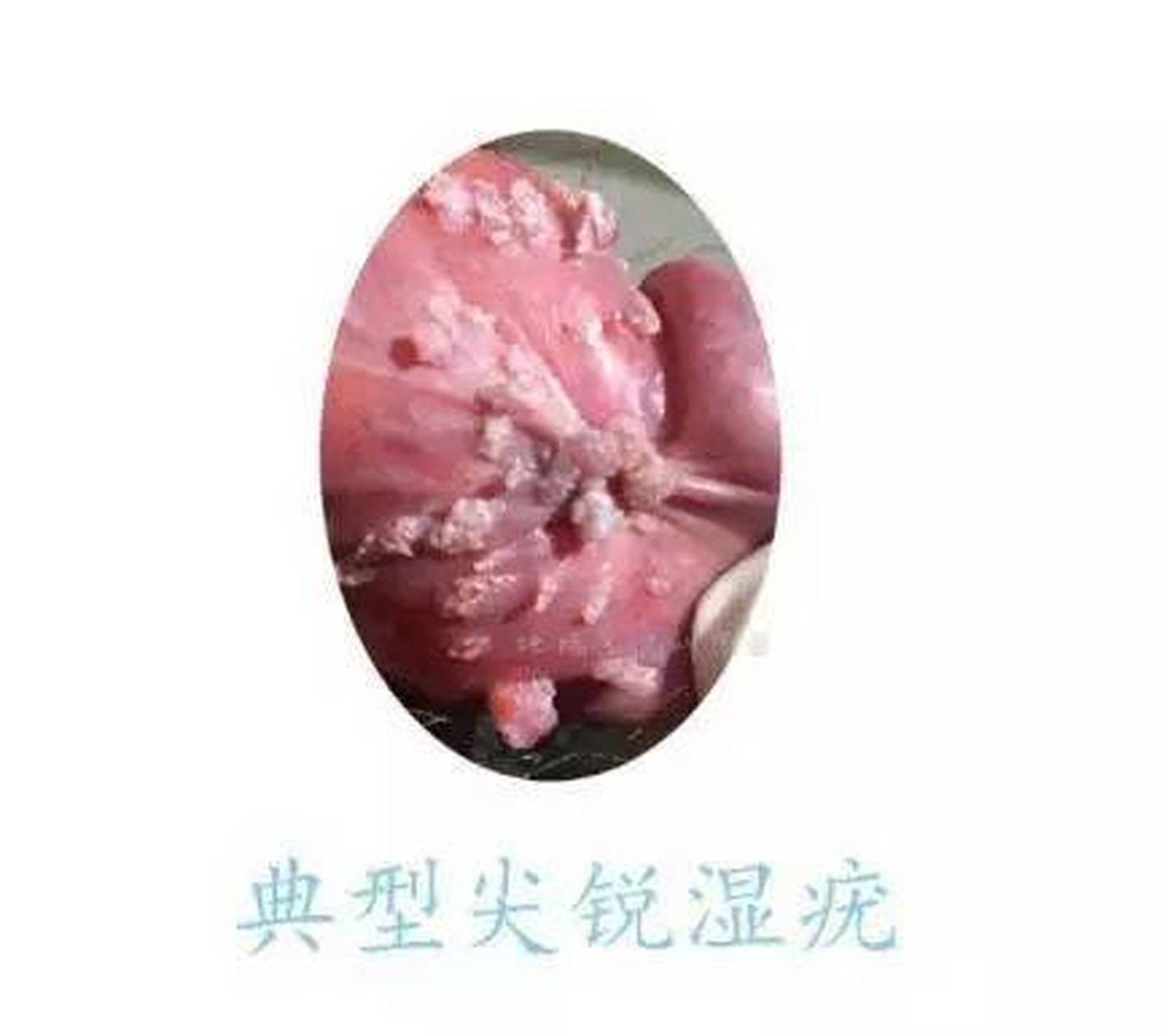 尖锐湿疣之外染毒邪证 外染毒邪证症见疣体增大迅速,有明确的不洁性交