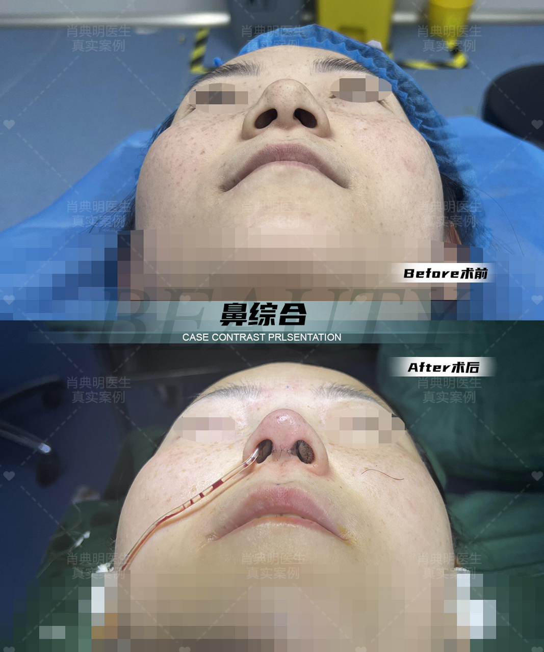 双侧耳软骨支架综合隆鼻,解决鼻头肥大,鼻小柱下垂,鼻根低平等问题.