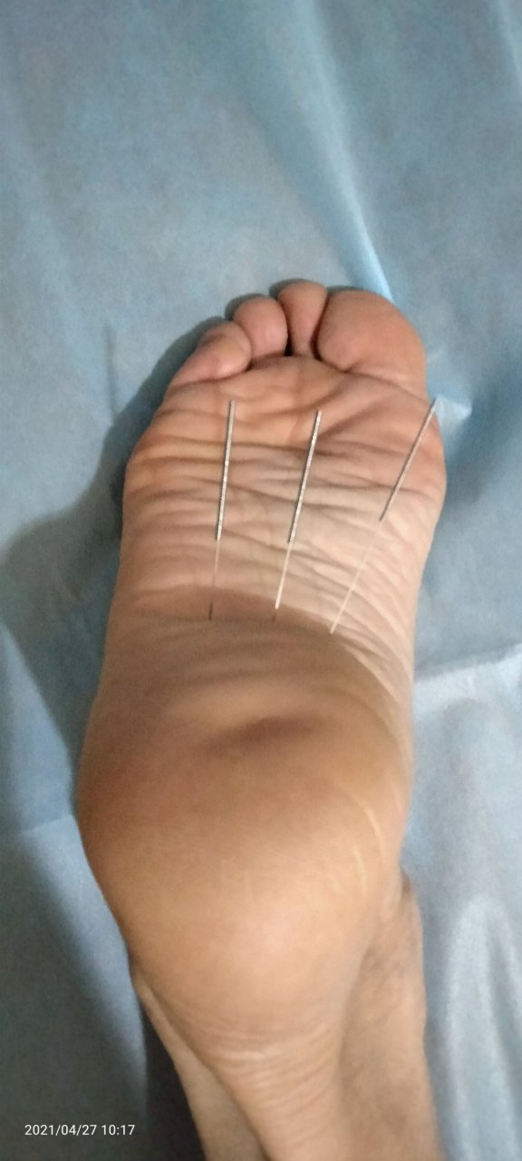 炉底三针,足底四白穴,加上旁开左右0.5寸,共三针.