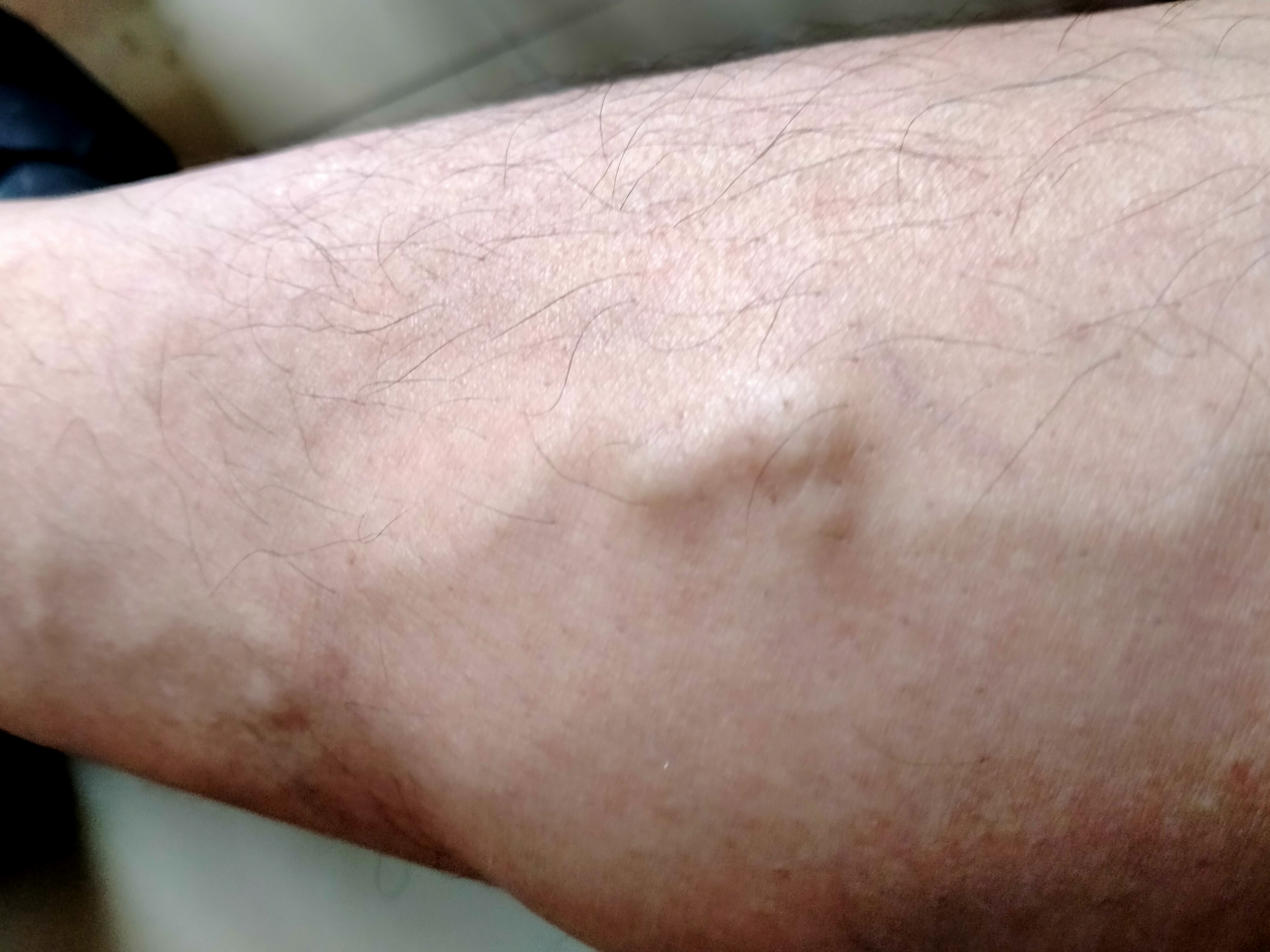 腿上血管突出,这是怎么回事?影响健康吗?