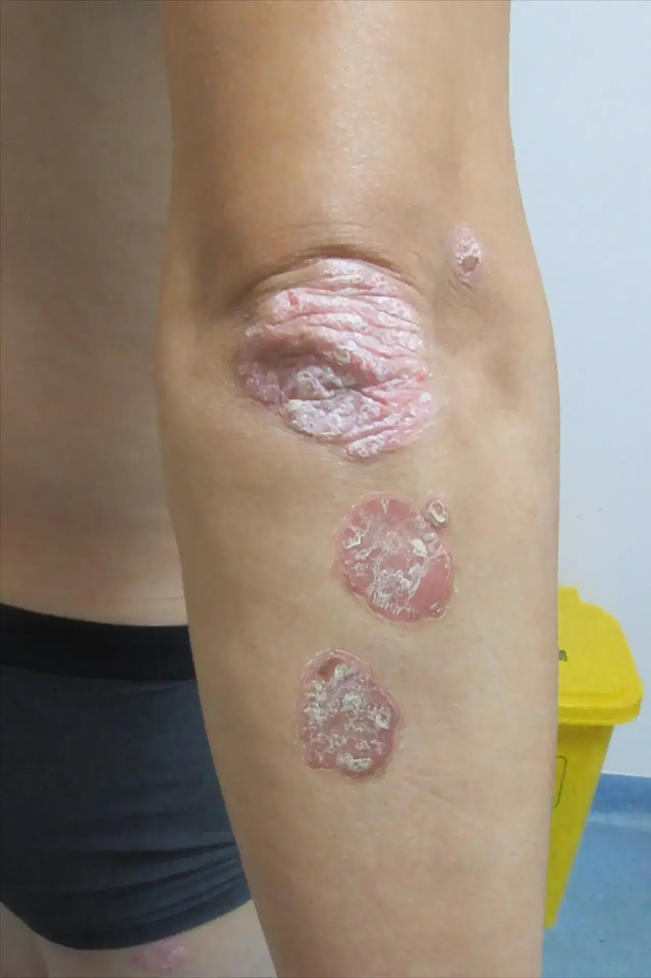 刘先生开车从韶关过来,手臂上的牛皮癣好了,也是没辜负他对我们的信任