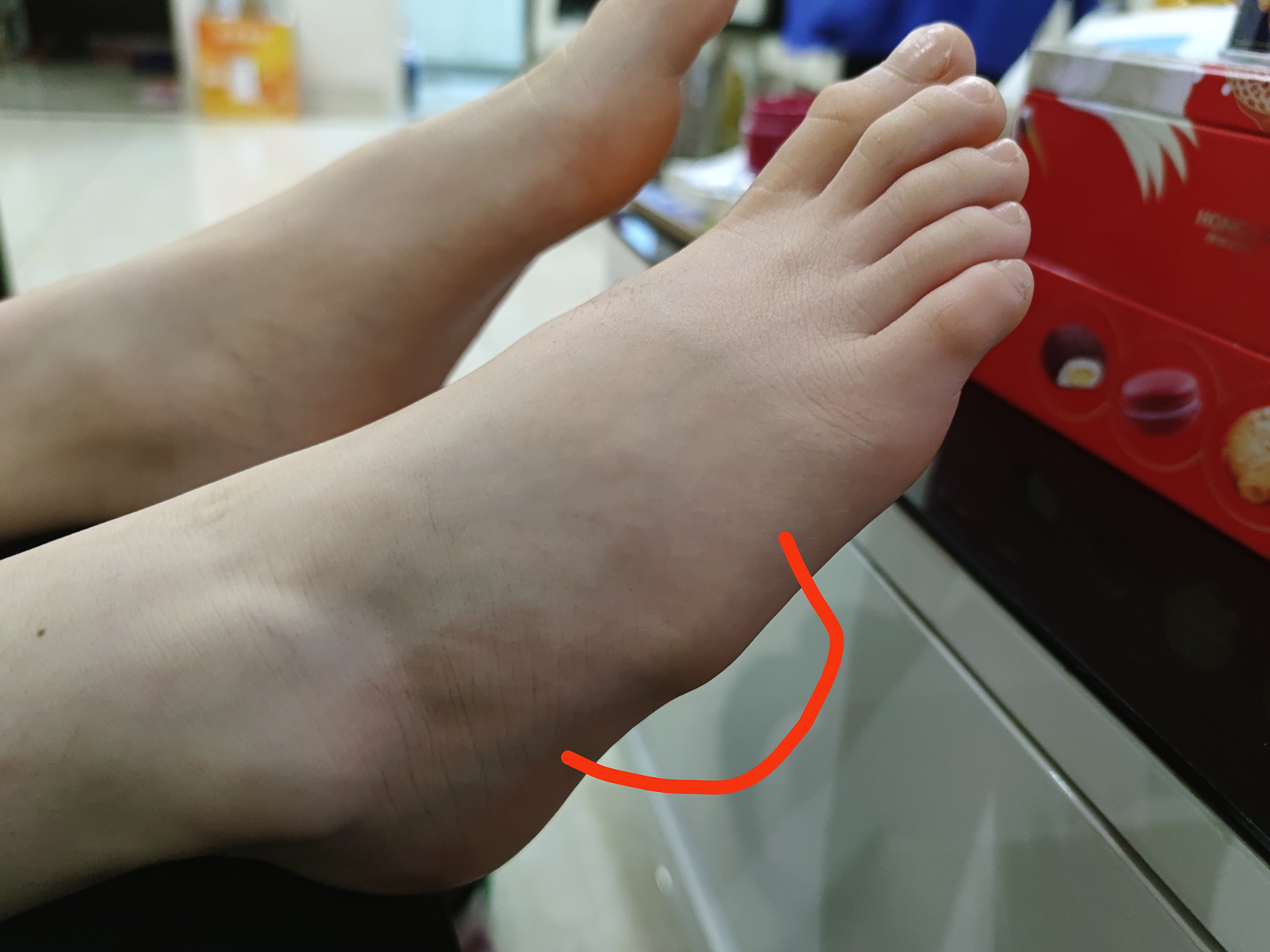 宝贝9岁,这两天发现两个脚外侧都有骨头突出.这两天来不及去医院.