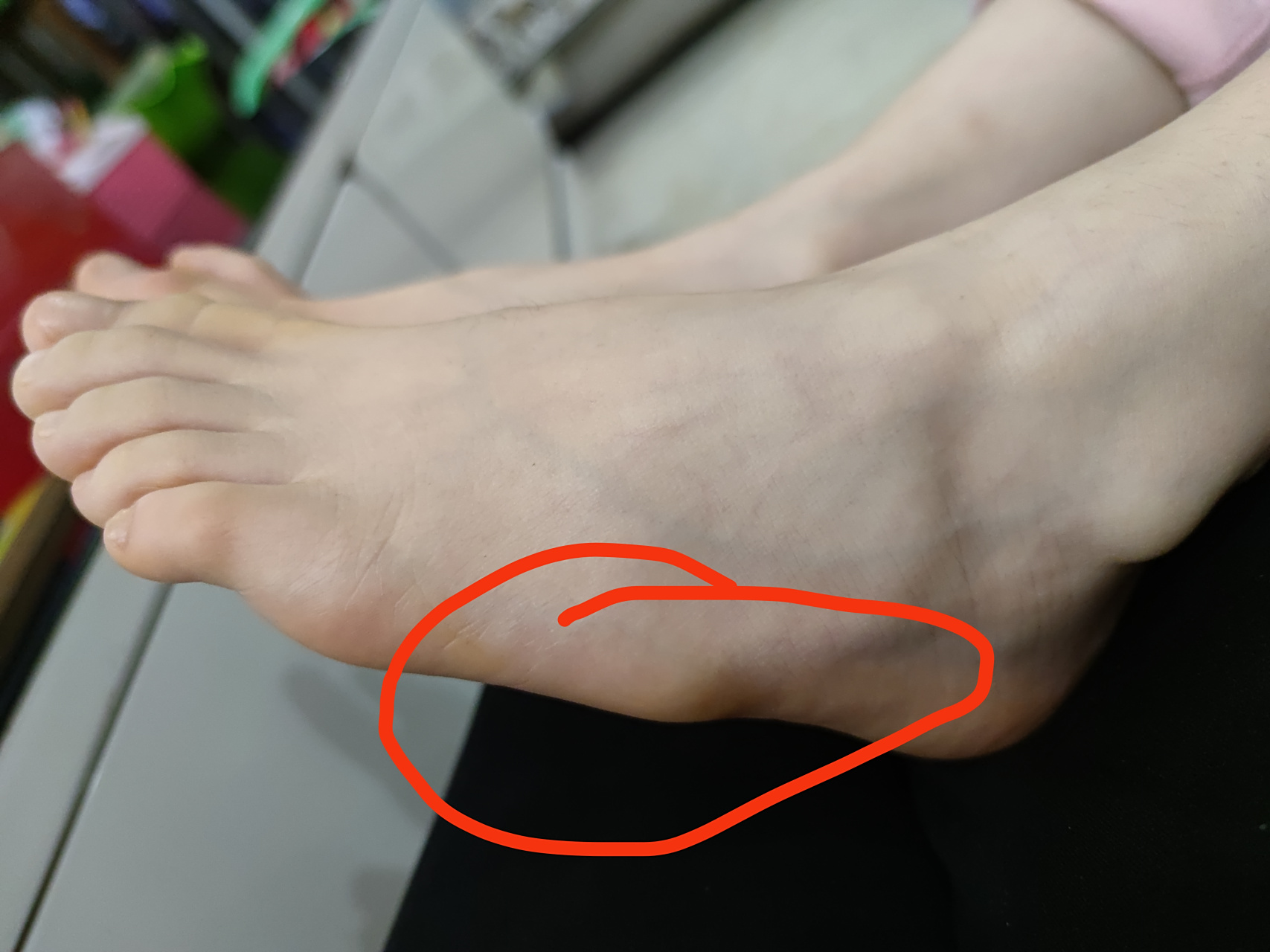 宝贝9岁,这两天发现两个脚外侧都有骨头突出.这两天来不及去医院.