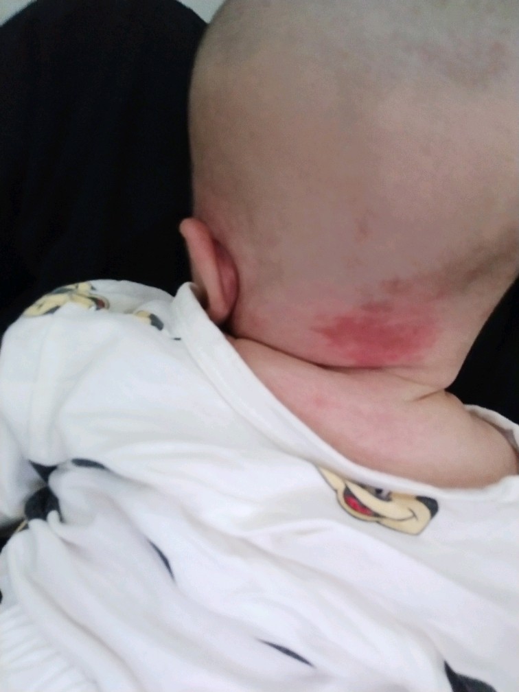 鲑鱼斑或"鹳咬痕".