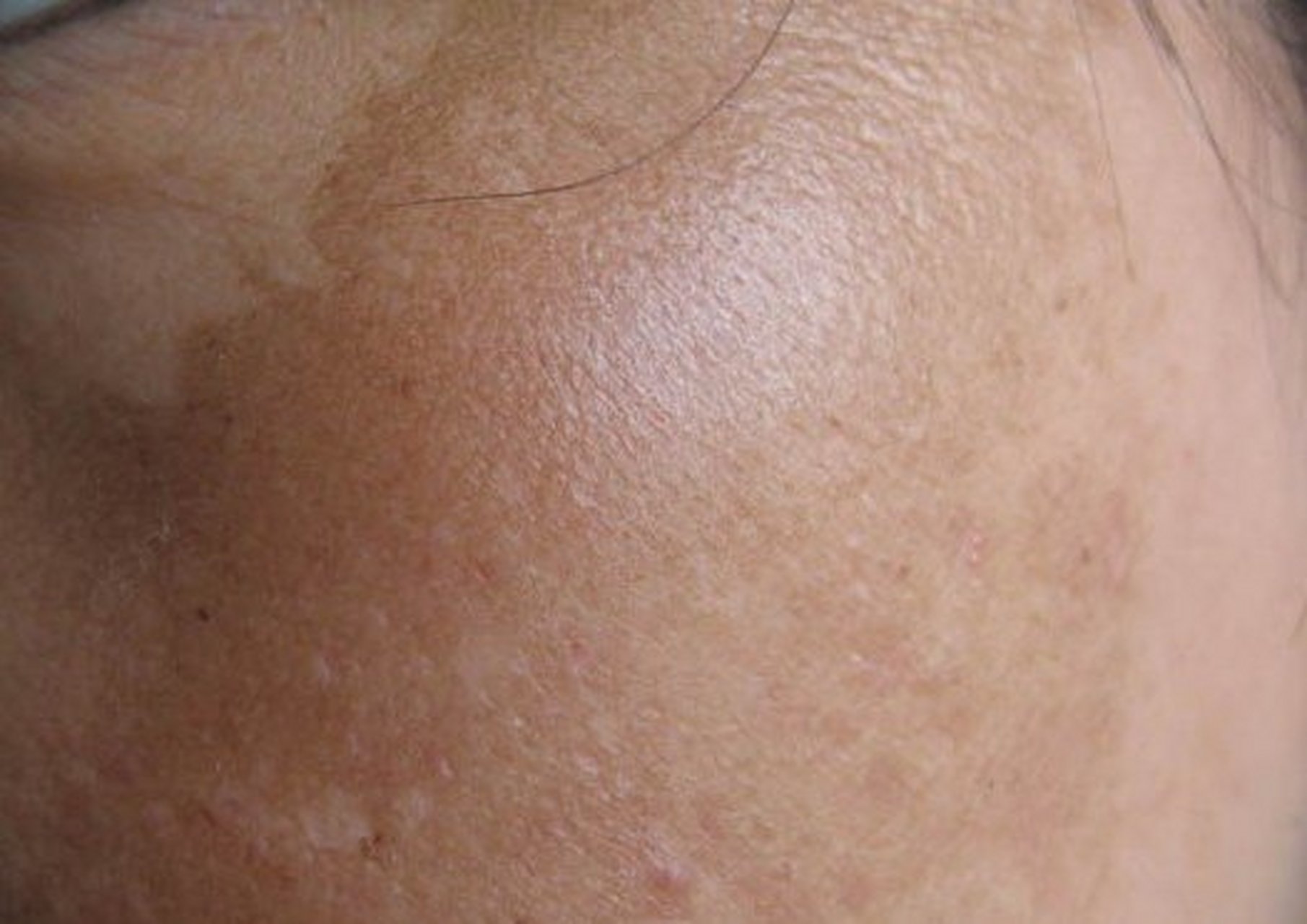 【肝硬化黄疸高,原因是什么】  肝硬化时部分病人出