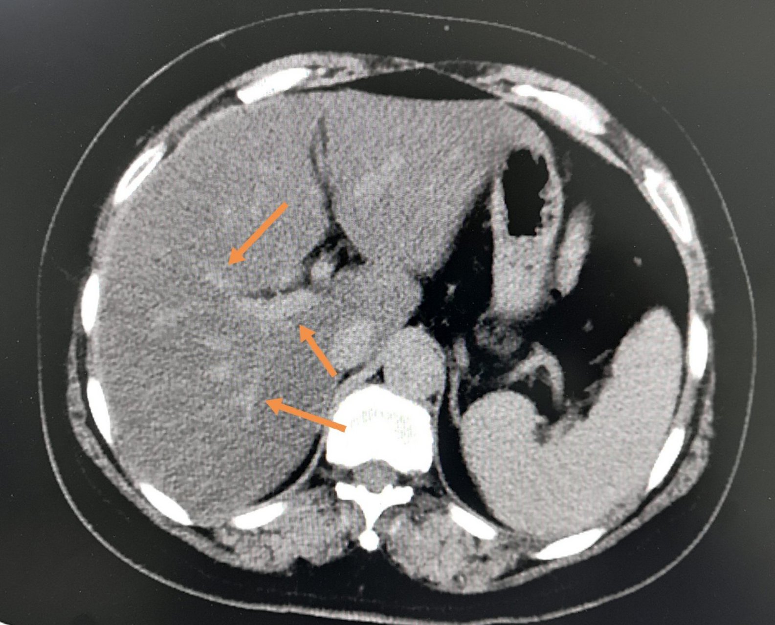 脂肪肝,ct片怎么看?
