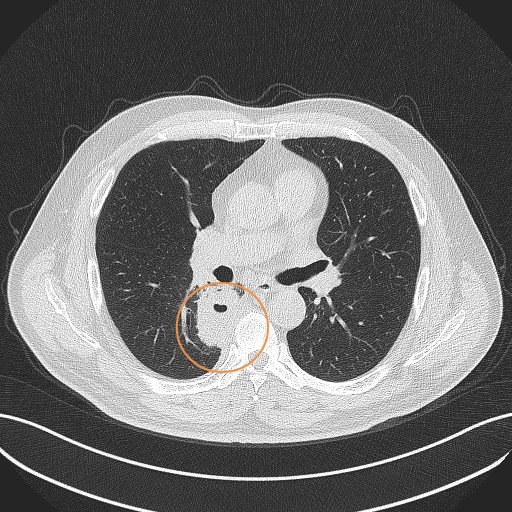 这是个肺脓肿,不是肺癌,别怕