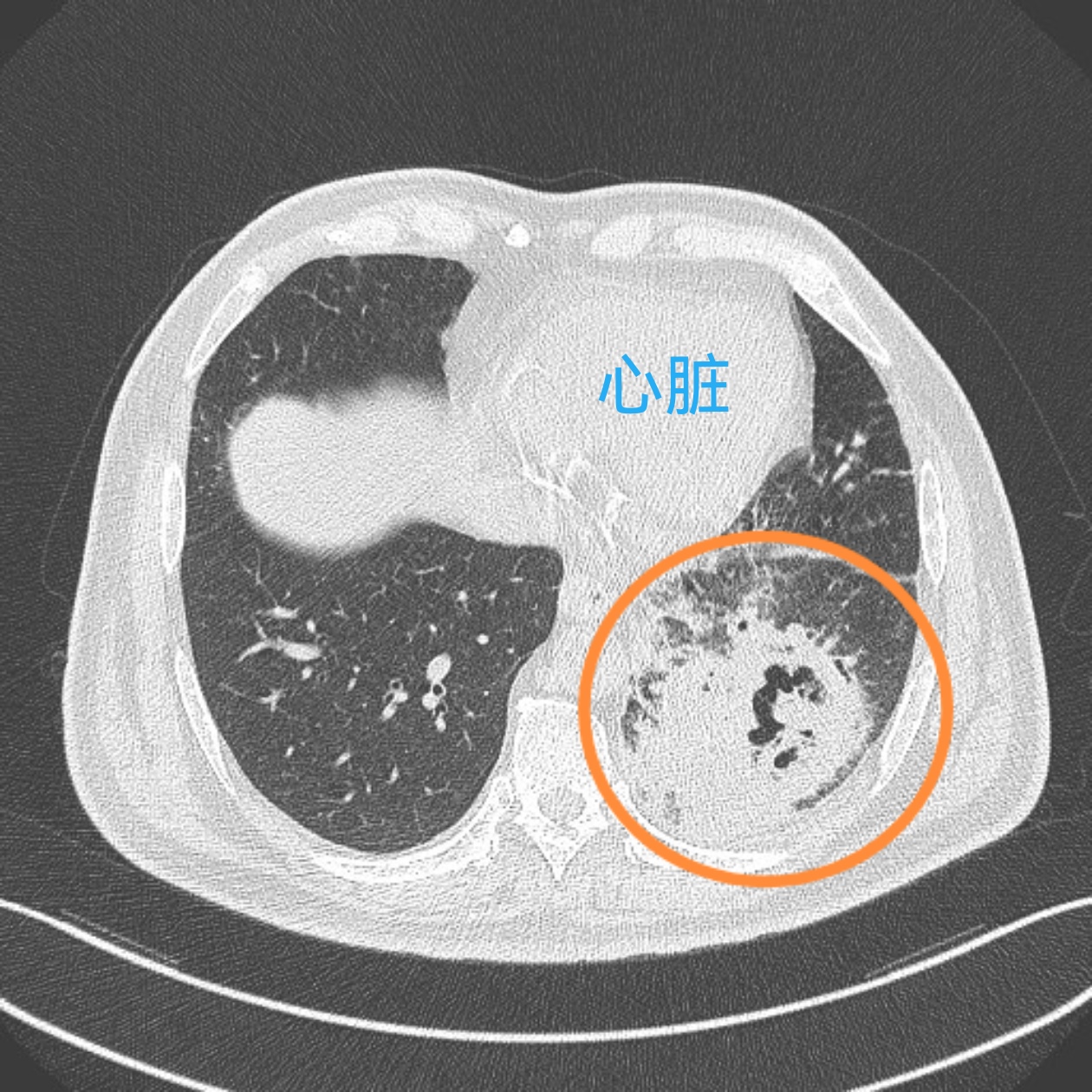 糖尿病这样做,很花钱