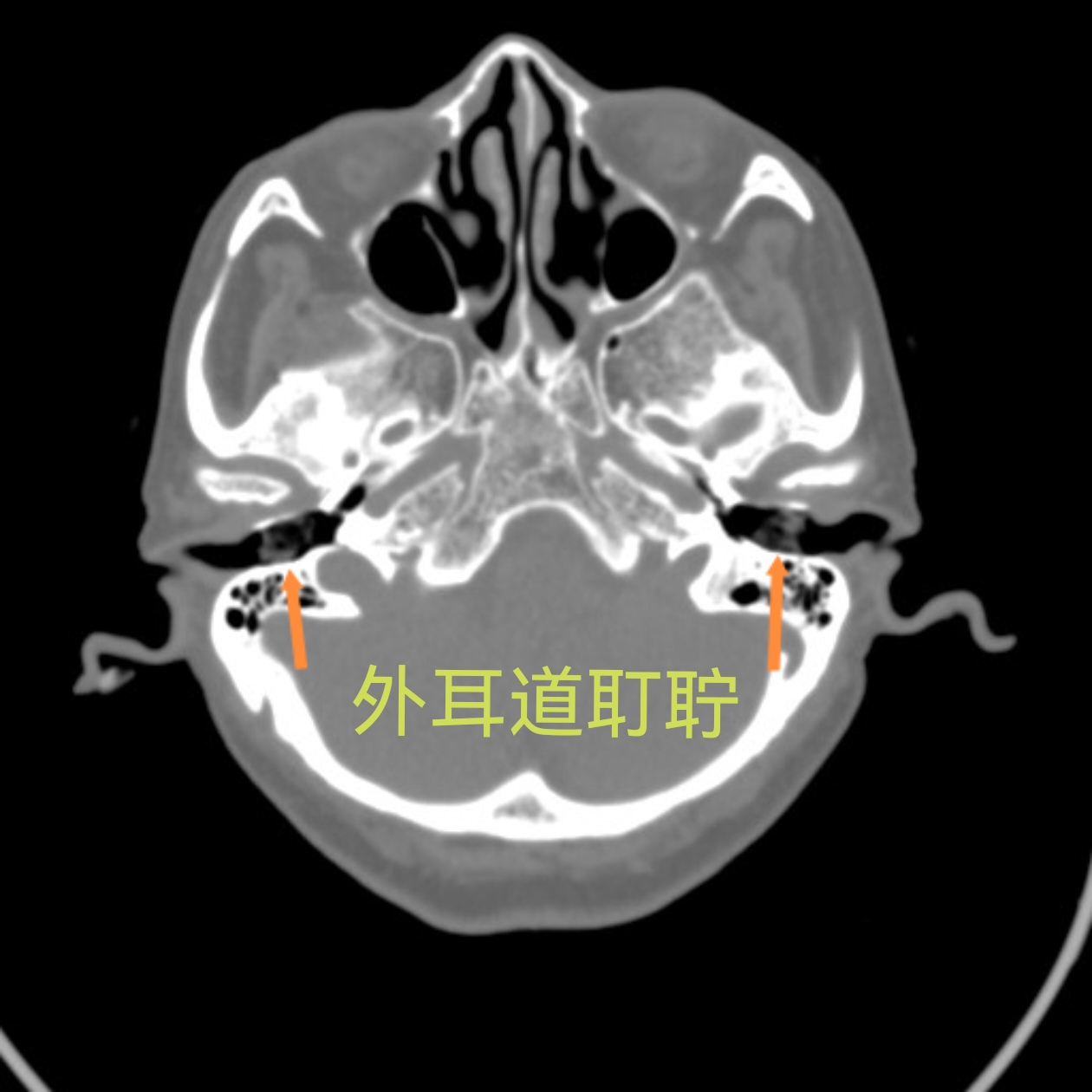 昨天不小心摔了一跤,磕到头了, 过来做了个ct