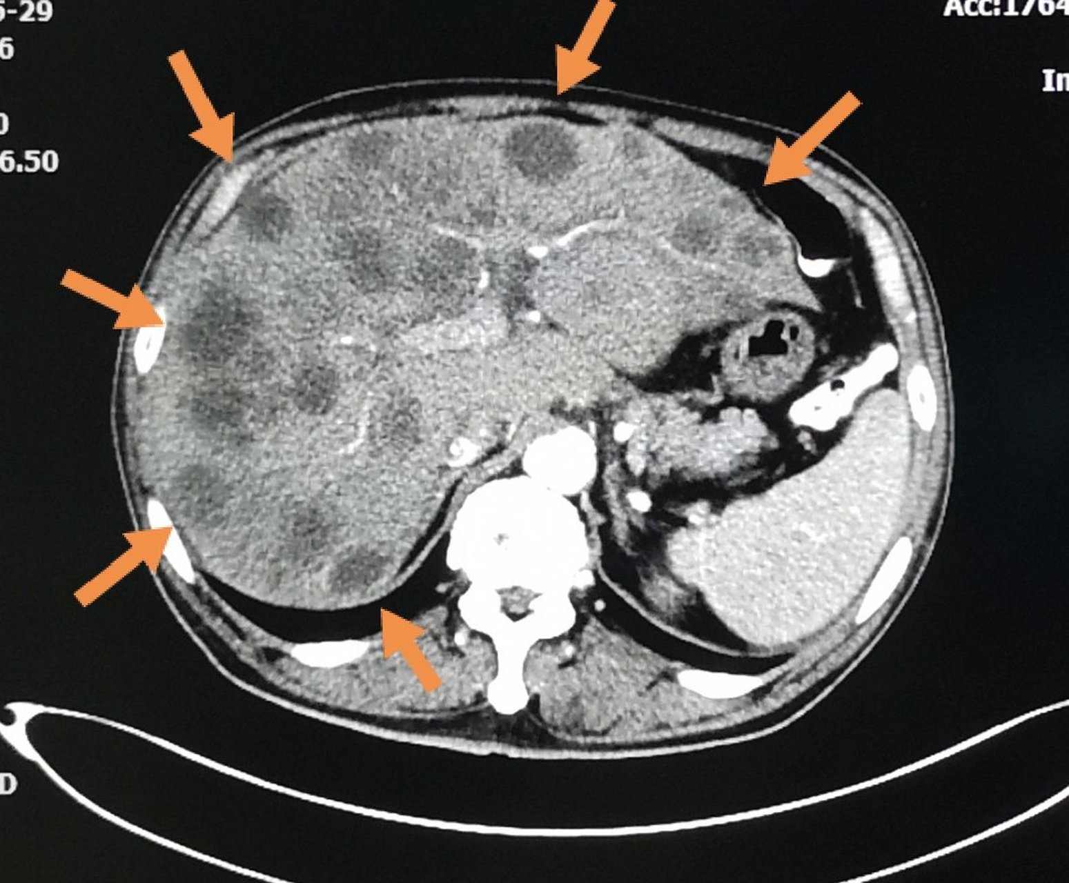 66岁老人,突然不爱吃饭3天,肚子胀, ct发现肝脏长了几十个圆形转移瘤