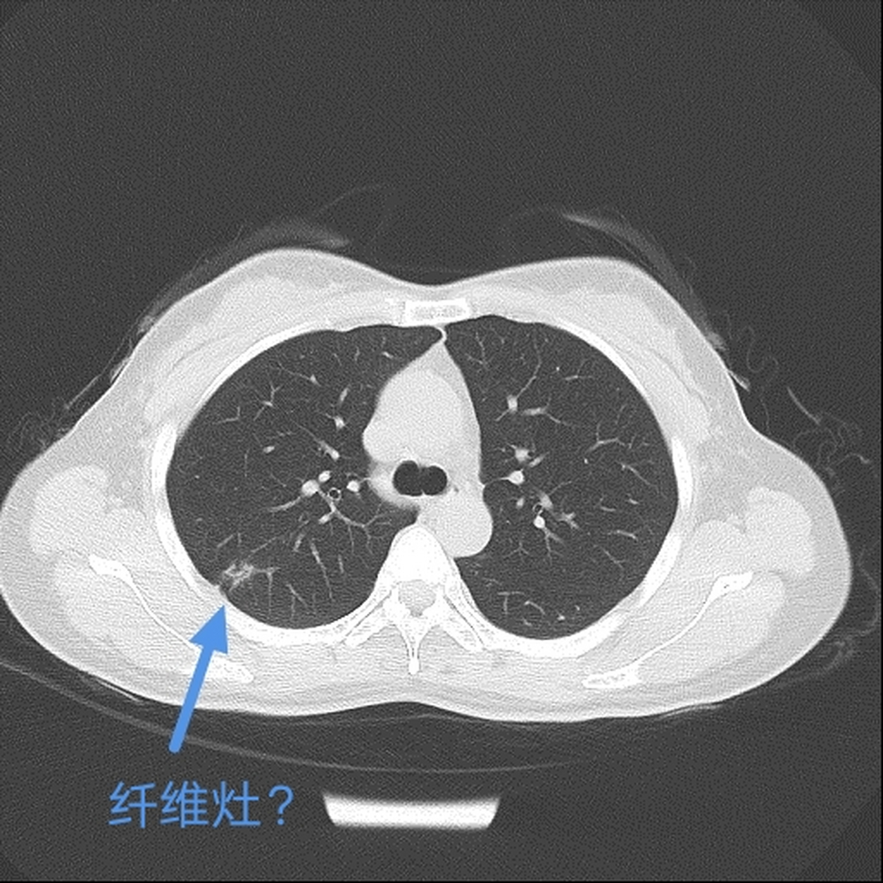 肺纤维灶图片