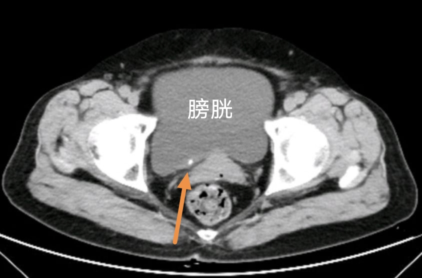 ct膀胱ct解剖图ct膀胱位置输尿管在ct图什么位置膀胱ct下腹部ct图解