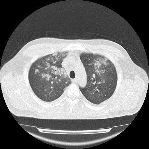 ct发现双肺多发的白色小斑片影,部分呈磨玻璃影,中上肺为主,沿肺