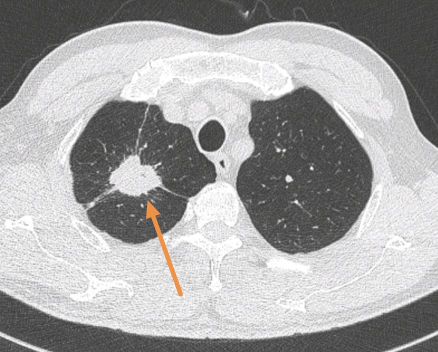 结果两人一交流,亲家是因为反复咳嗽3个月,做ct查出来的肺肿瘤