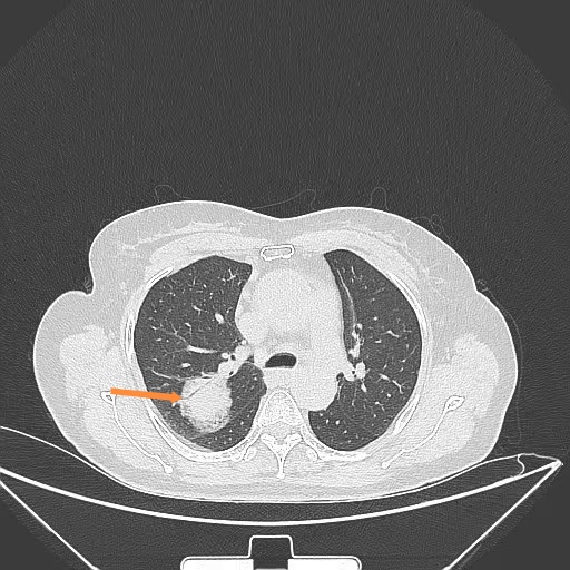 ,是个混合磨玻璃病灶,以实性成分为主,外中有