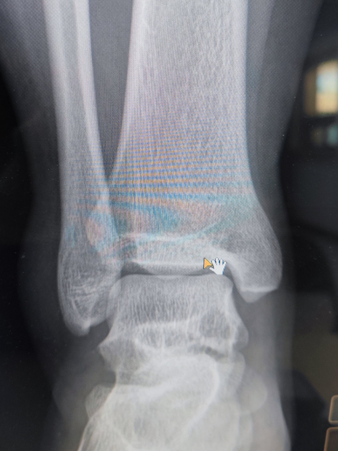 儿子的脚走路不小心崴了,肿得厉害,去医院拍完片子