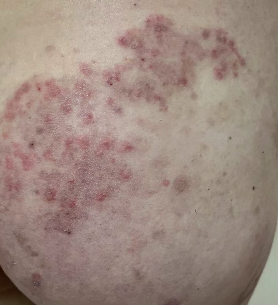 屁股上长了一片.很痒痒