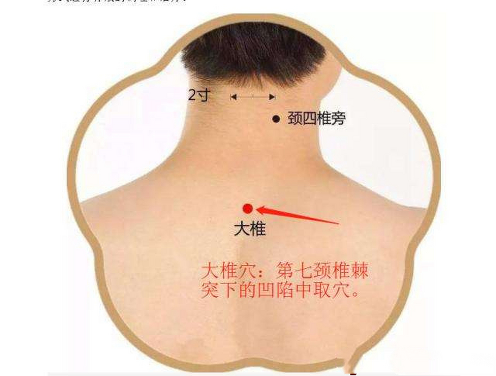 后颈窝的准确位置图图片
