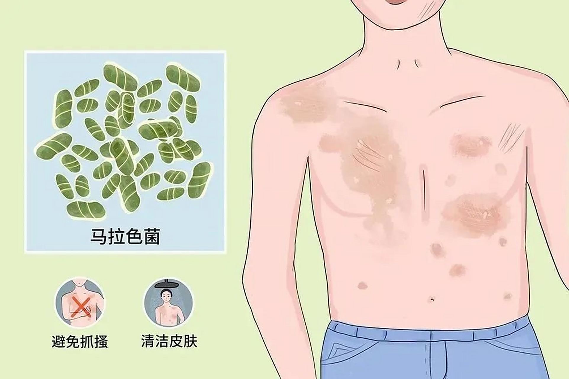 身体有不痛不痒的"汗斑",怎么办?