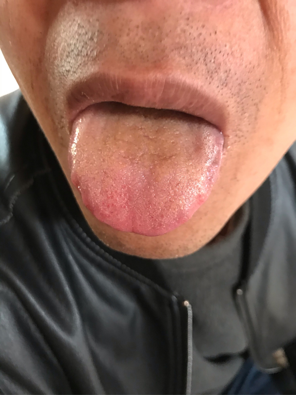 热点!舌苔厚白的6个最快消除方法"助孕买卵"-第2张图片-瑞康博客