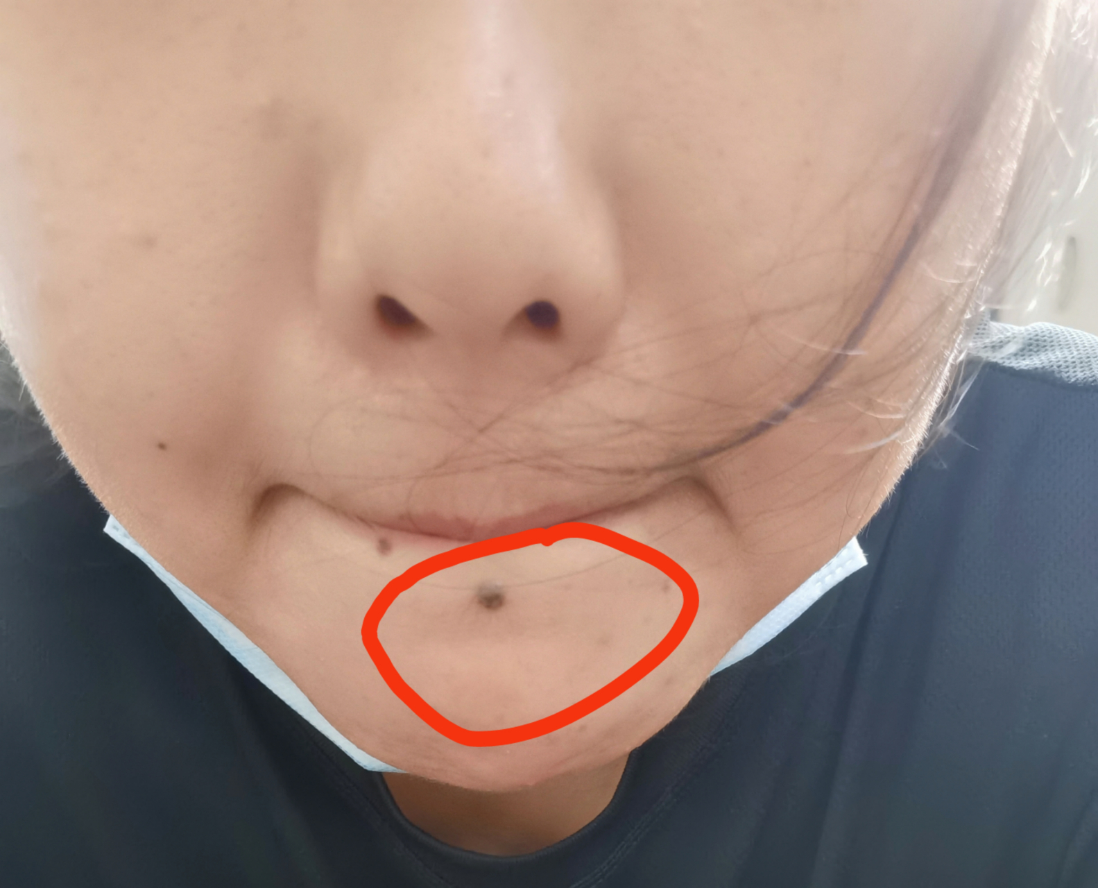 有没有会看面相的,我这里的痦子可以去掉吗?在线等,急