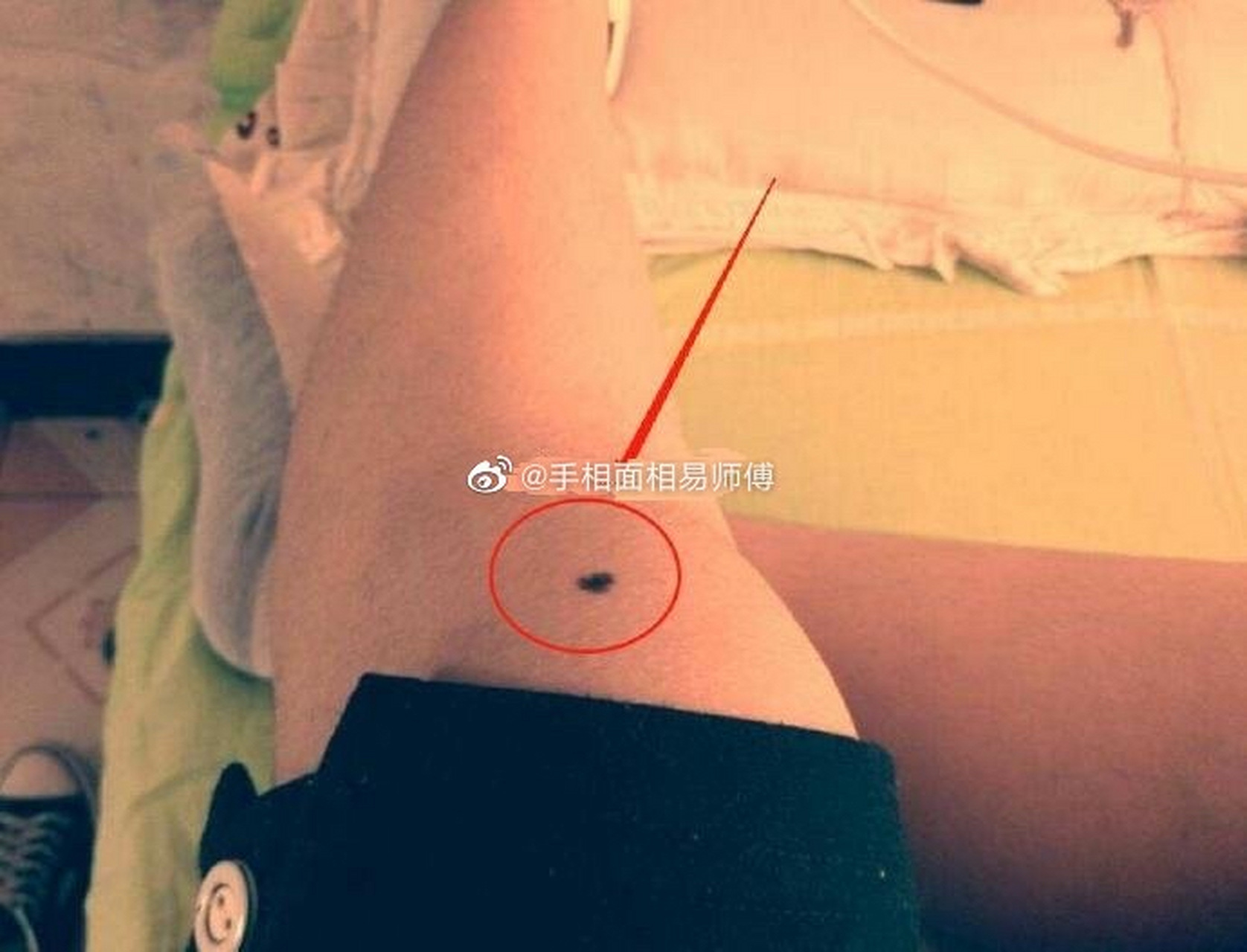 1,跌灾痣 长在左腿膝盖左侧面,这颗痣是凶痣.