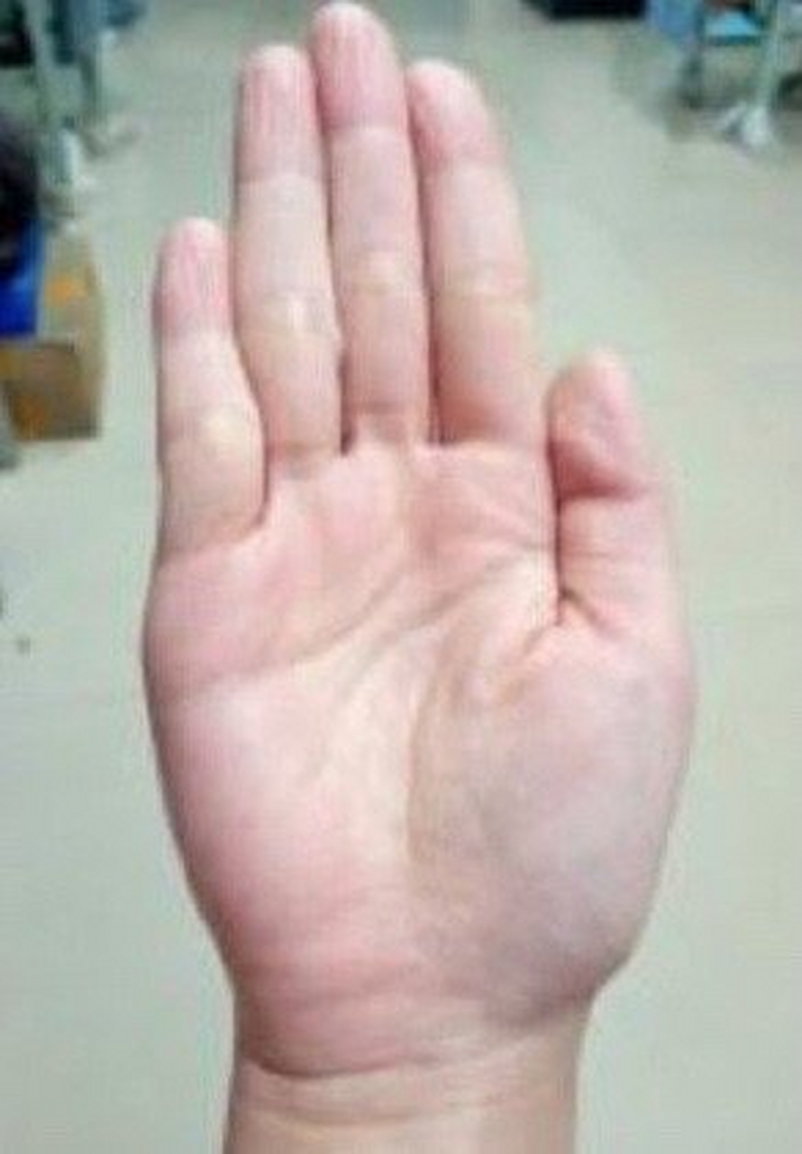 手相分析:  掌色粉红金星丘带竖纹多有贵人帮衬,从小福分佳,生命线