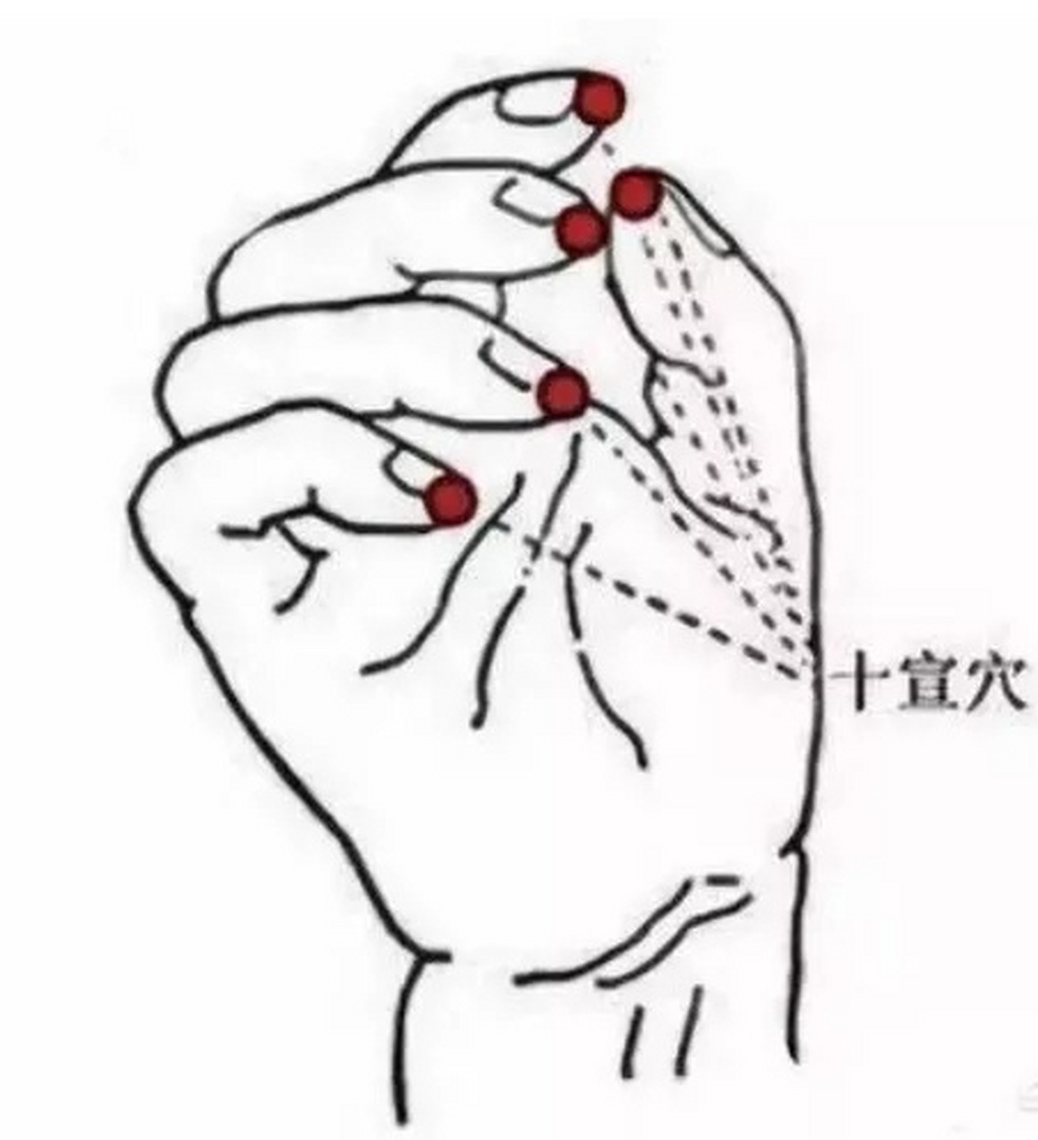 十指刺血退烧  发热时采用放血疗法有一定的效果.