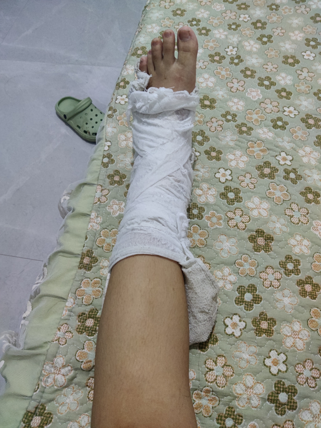 图片腿包扎绷带肿了的真实图片受伤的腿绷带图片腿受伤包扎在在家图片