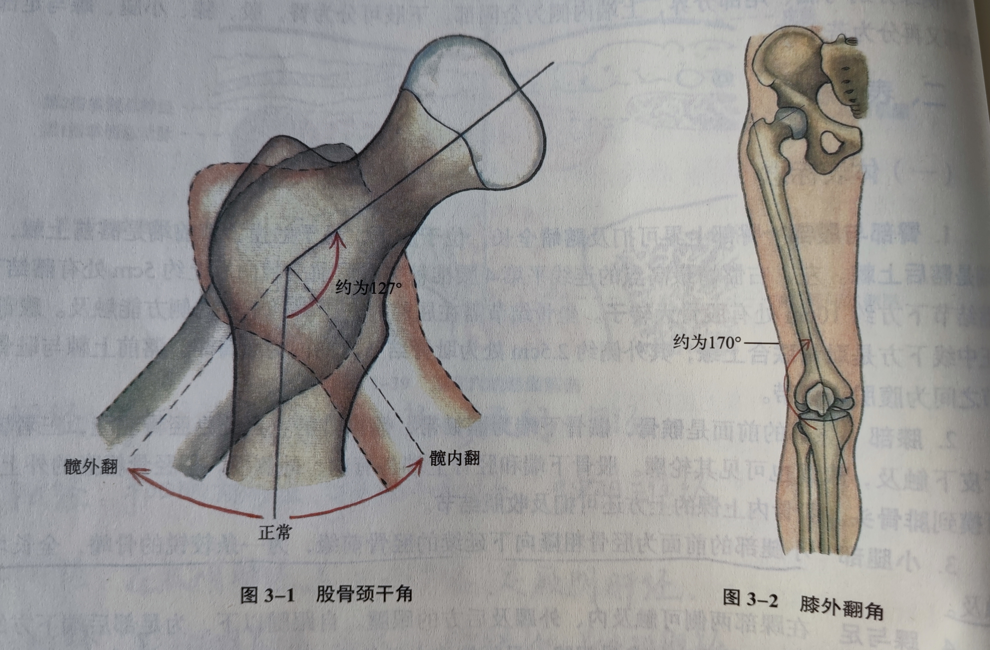 儿童髋关节颈干角增大图片