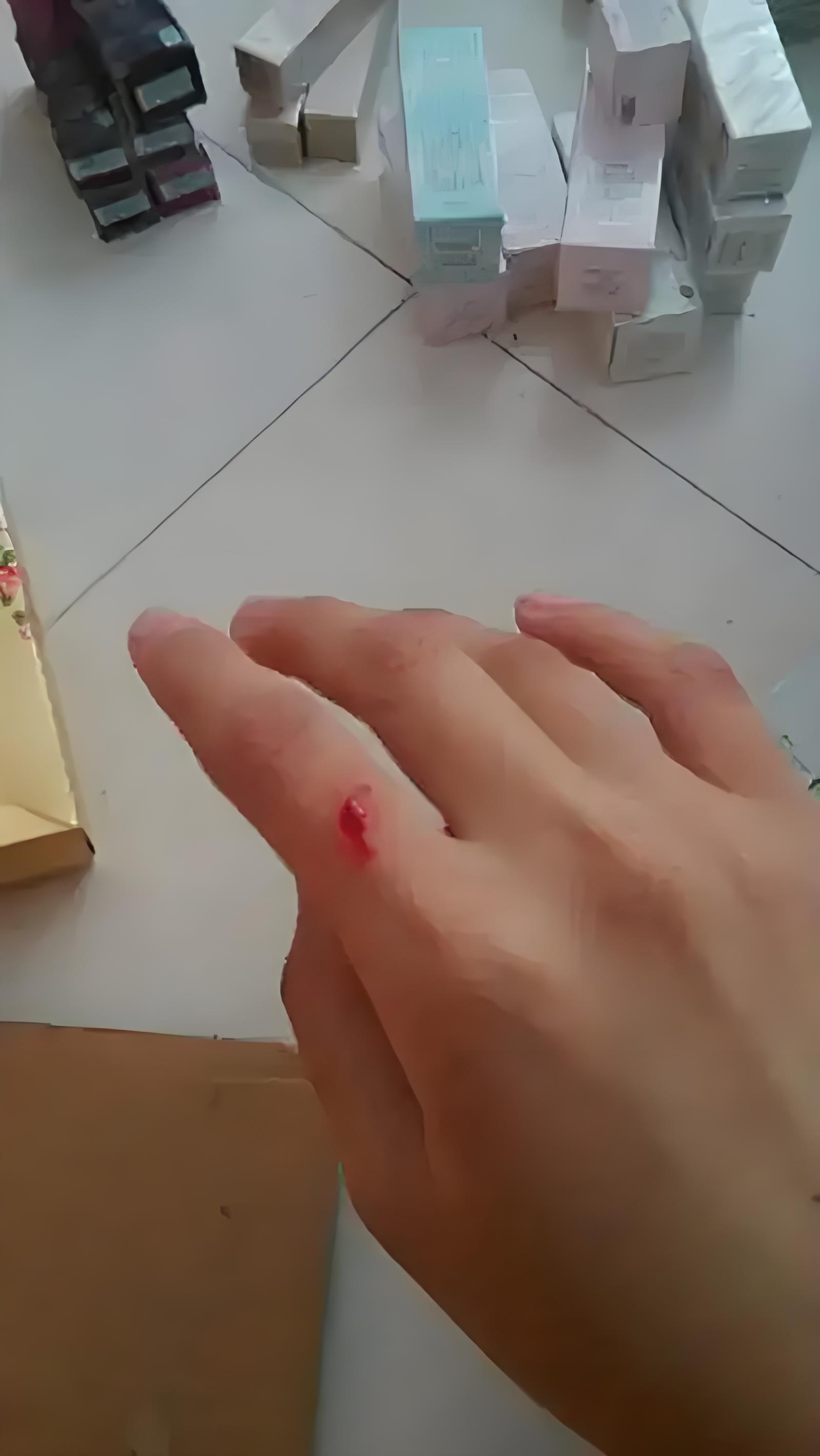 手受伤流血了好痛啊,真倒霉