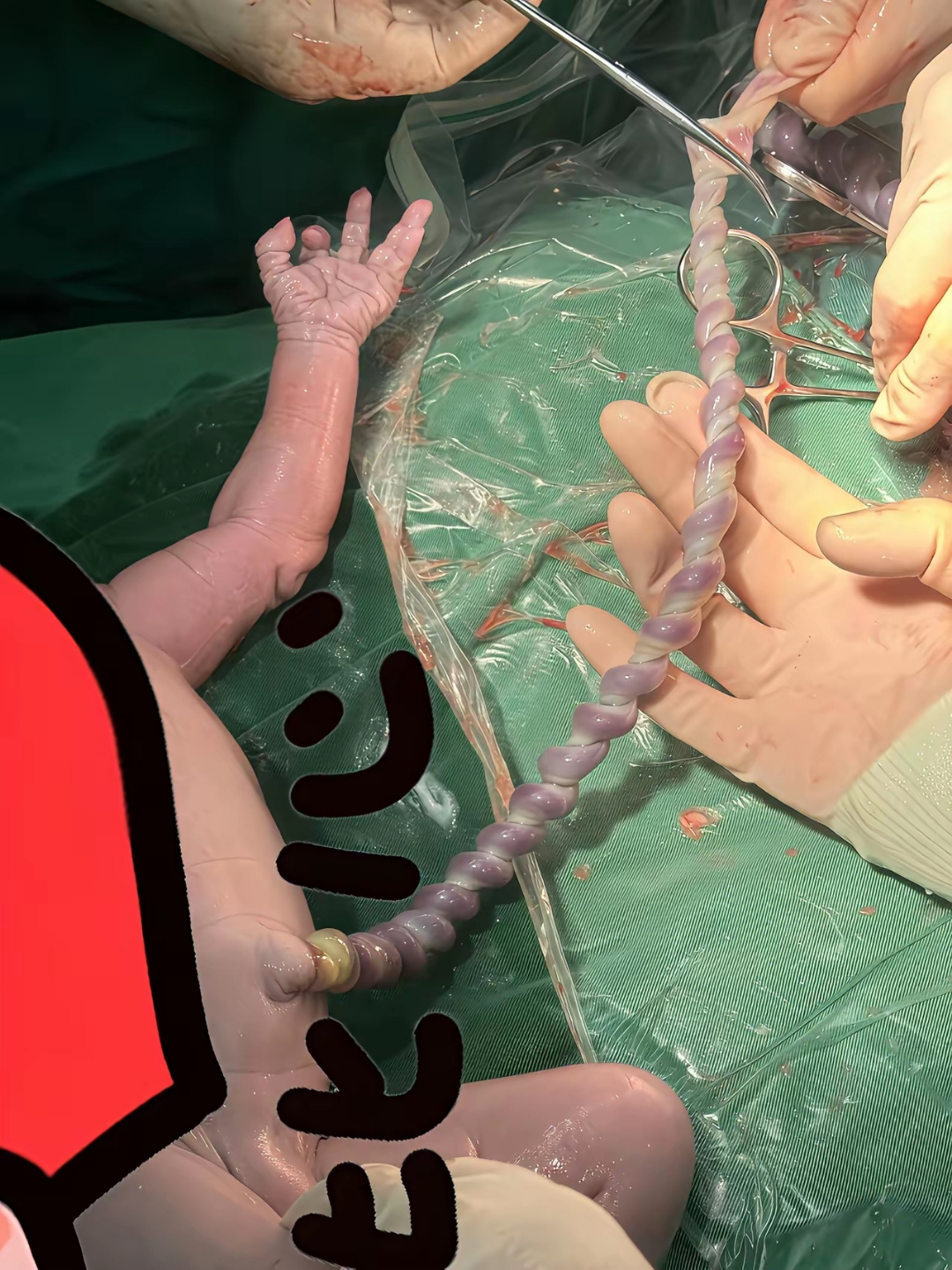 孕妈妈一定数好胎动,看看这个调皮的小宝宝,把脐带完成麻花样子了