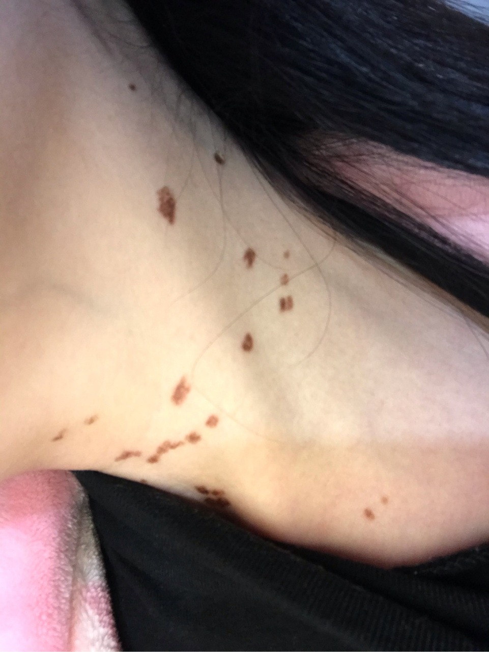 今天是扁平疣激光后的第7天,伤口全部结痂了,用手摸上去硬硬干干的