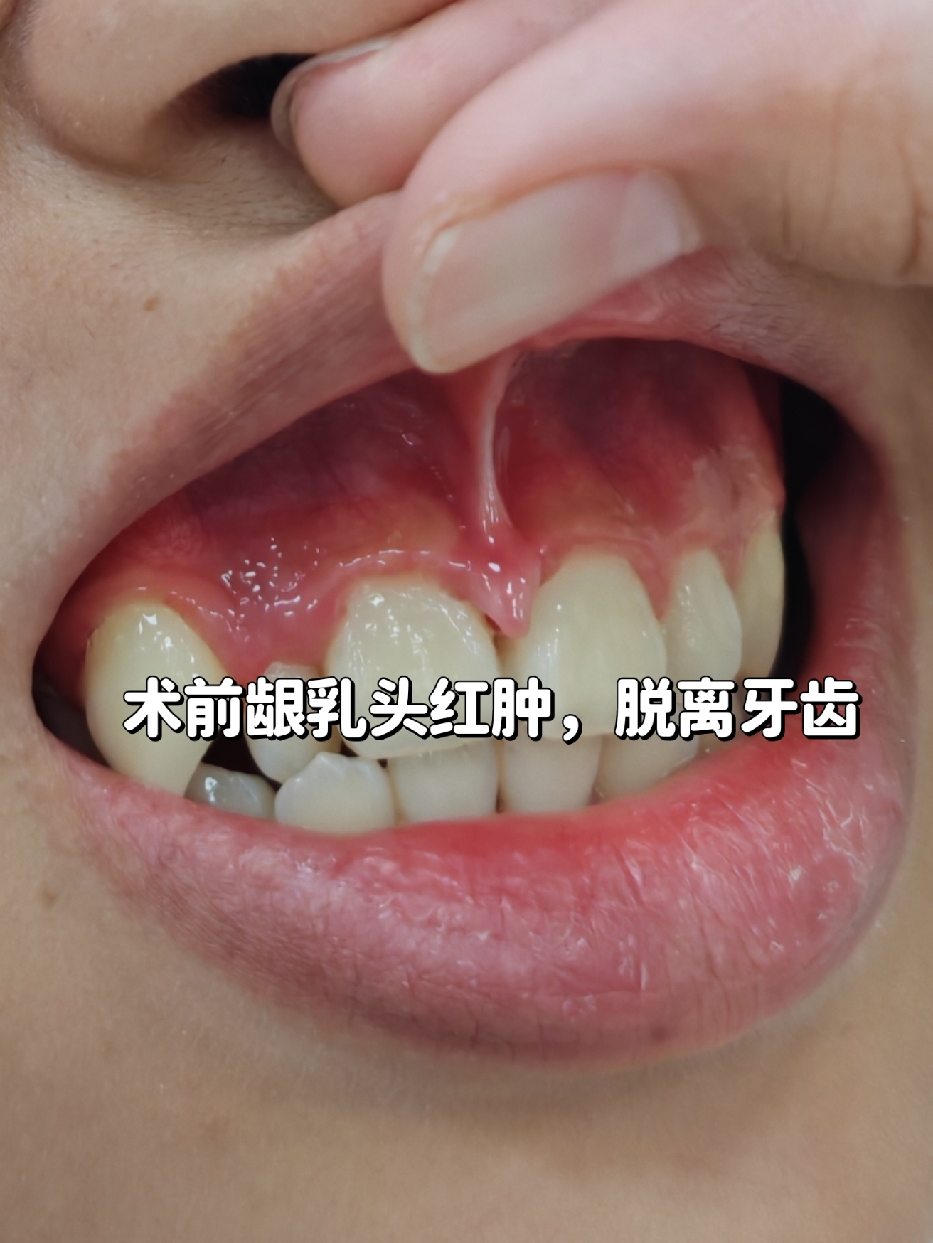 唇系带激光术前后对比图 手术.@老四是三娃妈的动态