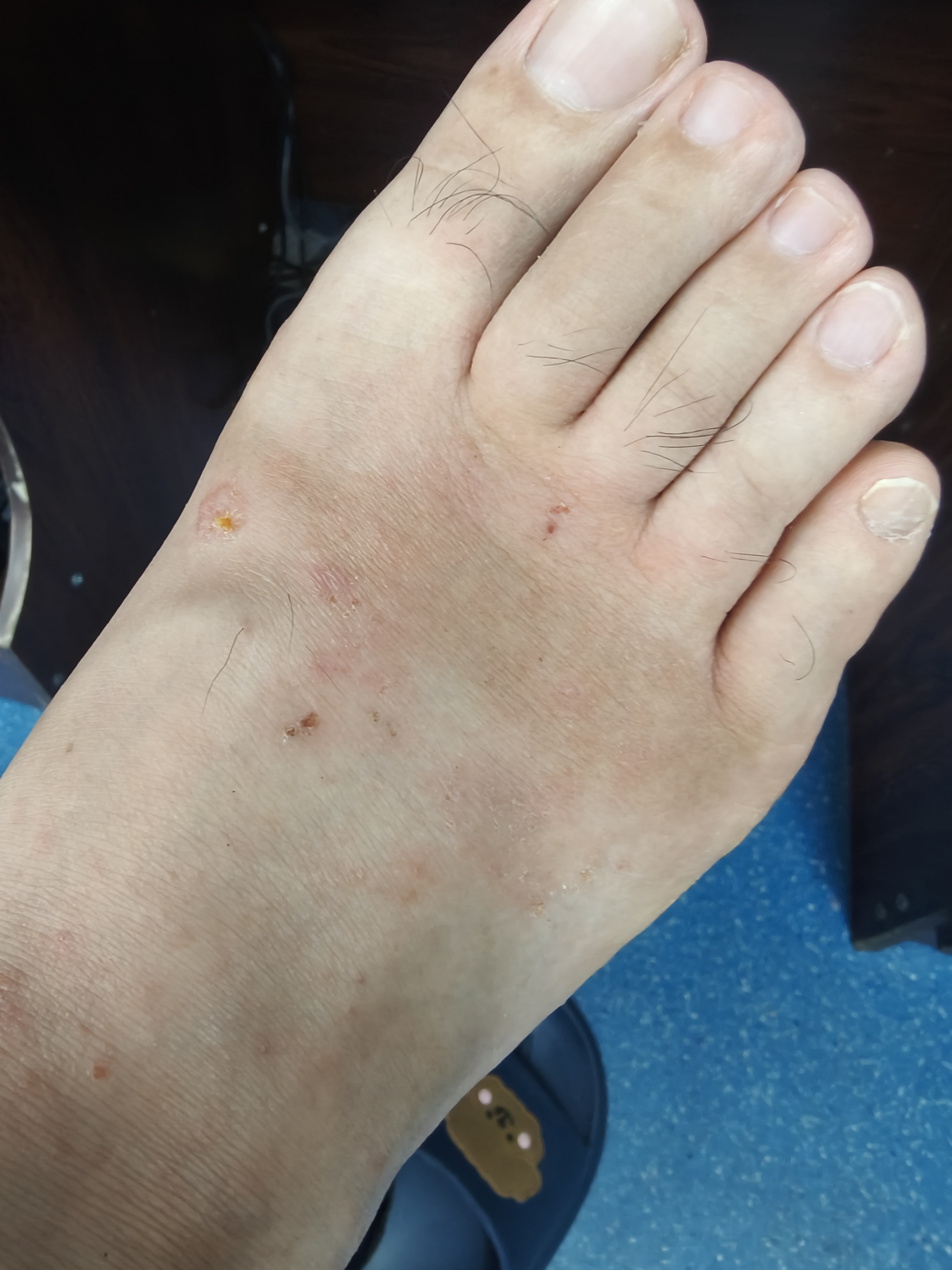 开始起一些红疙瘩,非常痒,挠破了就不痒了但往出流水