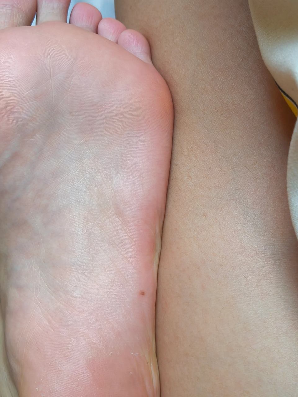 我的脚底有颗浅色黑痣