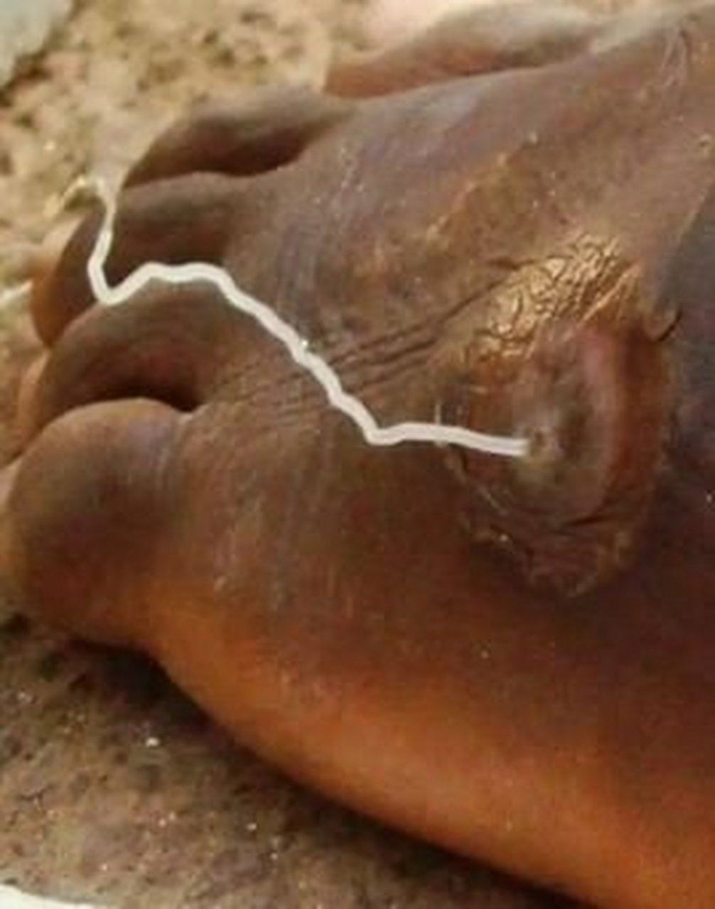 这是一种寄生,是17世纪在非洲几内亚发现的,所以叫几内亚龙线虫,长达