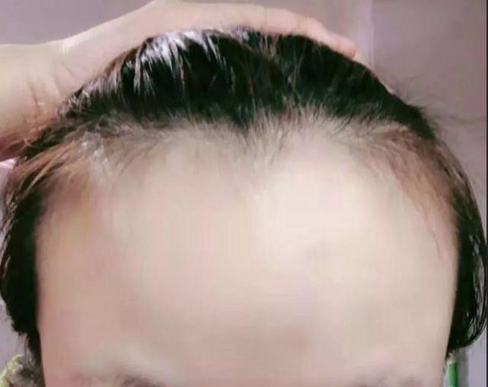 发际线后移让多少人都陷入痛苦之中!