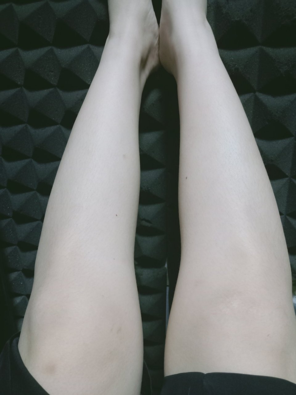 小腿内侧双腿都有痣 这是什么痣?