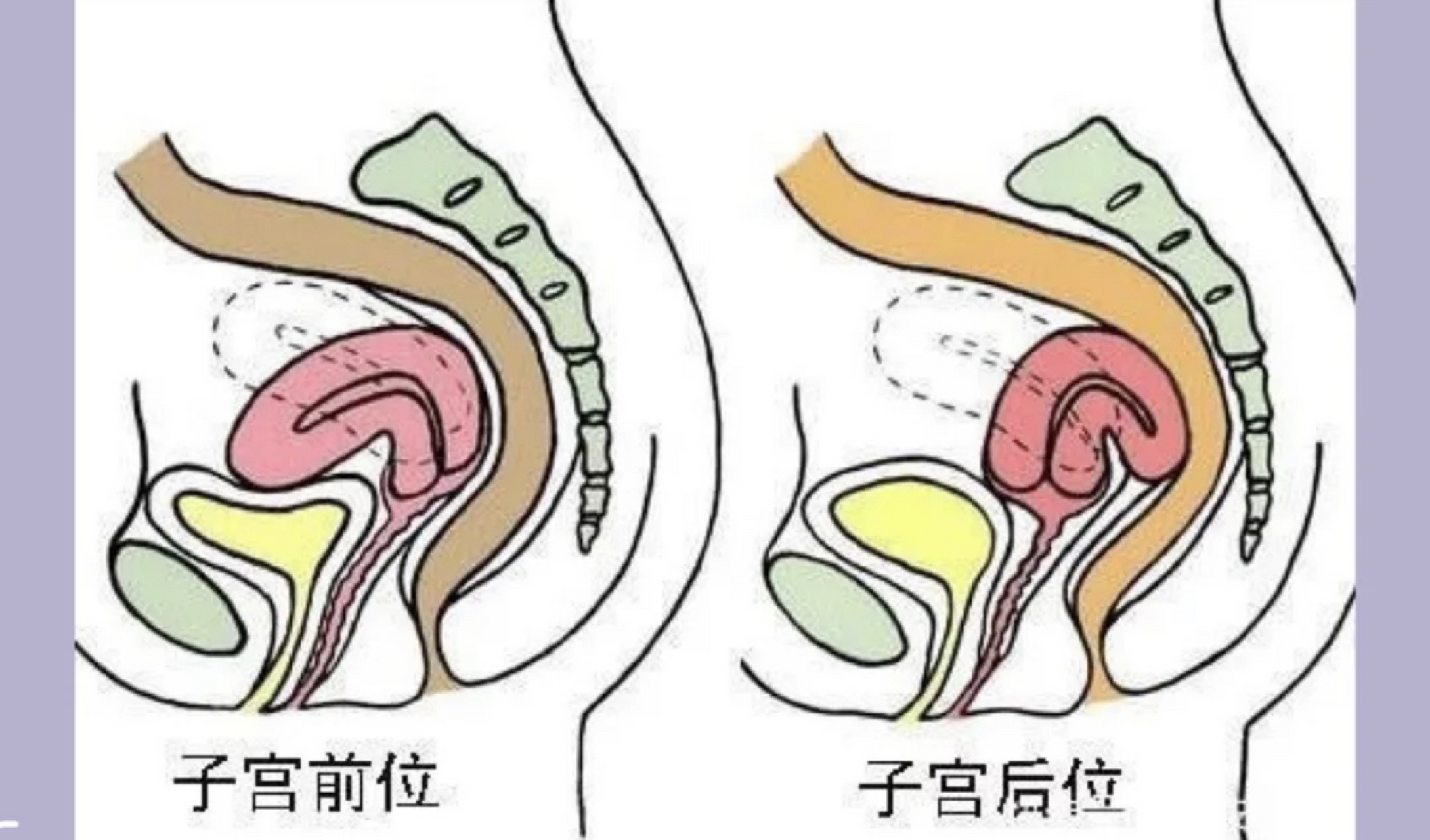 你知道子宫前位和子宫后位是什么样的吗?