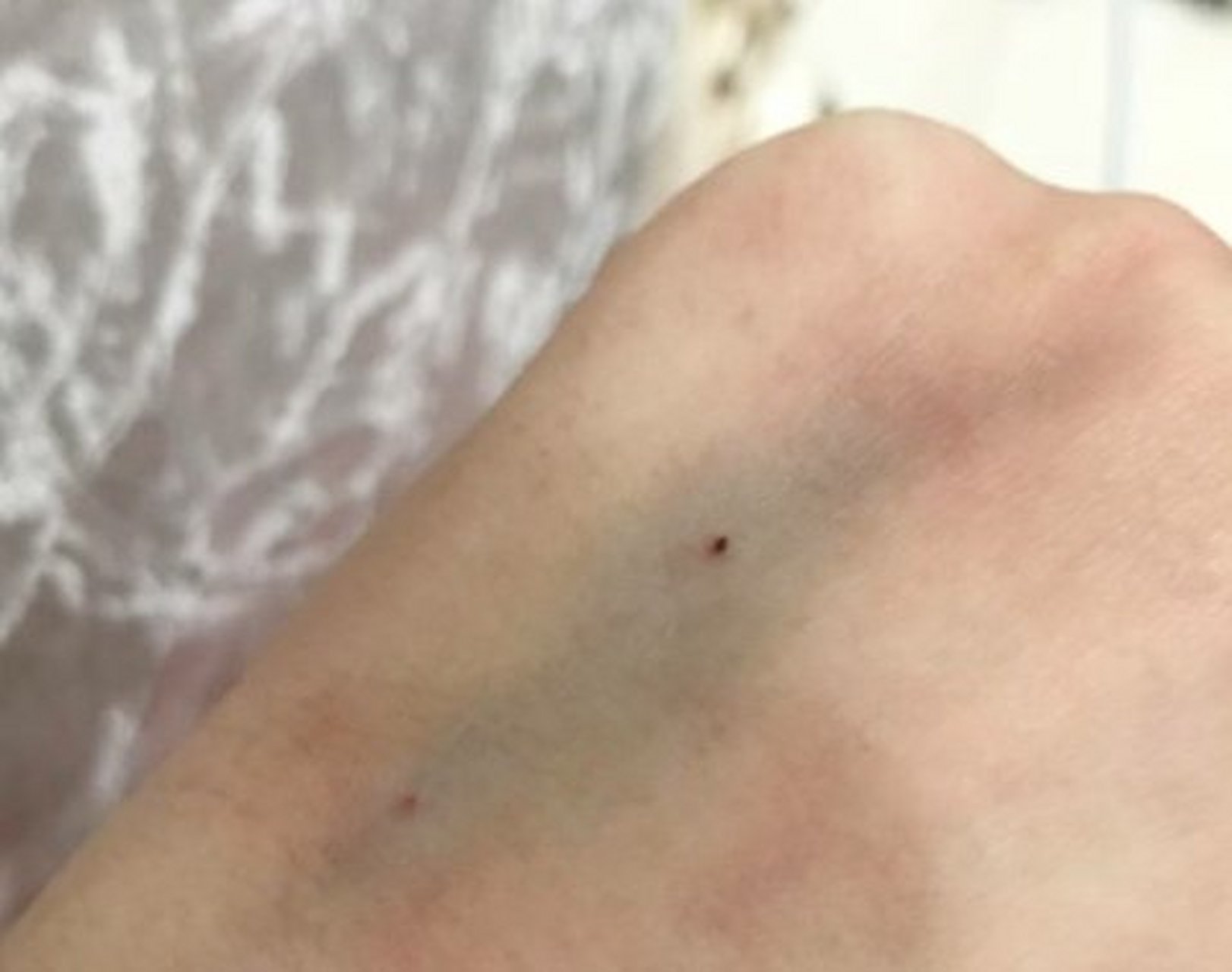 输完液拔针后,很多人按压止血的方法不对,导致淤青,渗血.