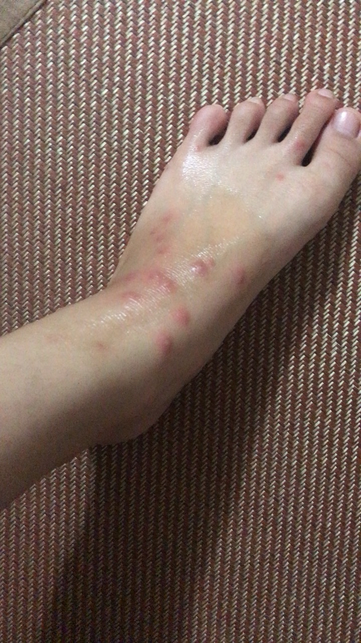 被蚂蚁咬了不知道是什么蚂蚁痒了好几天了
